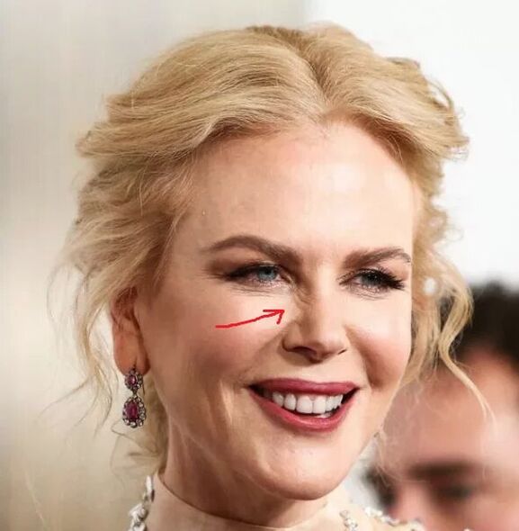 Alternatif untuk Botox